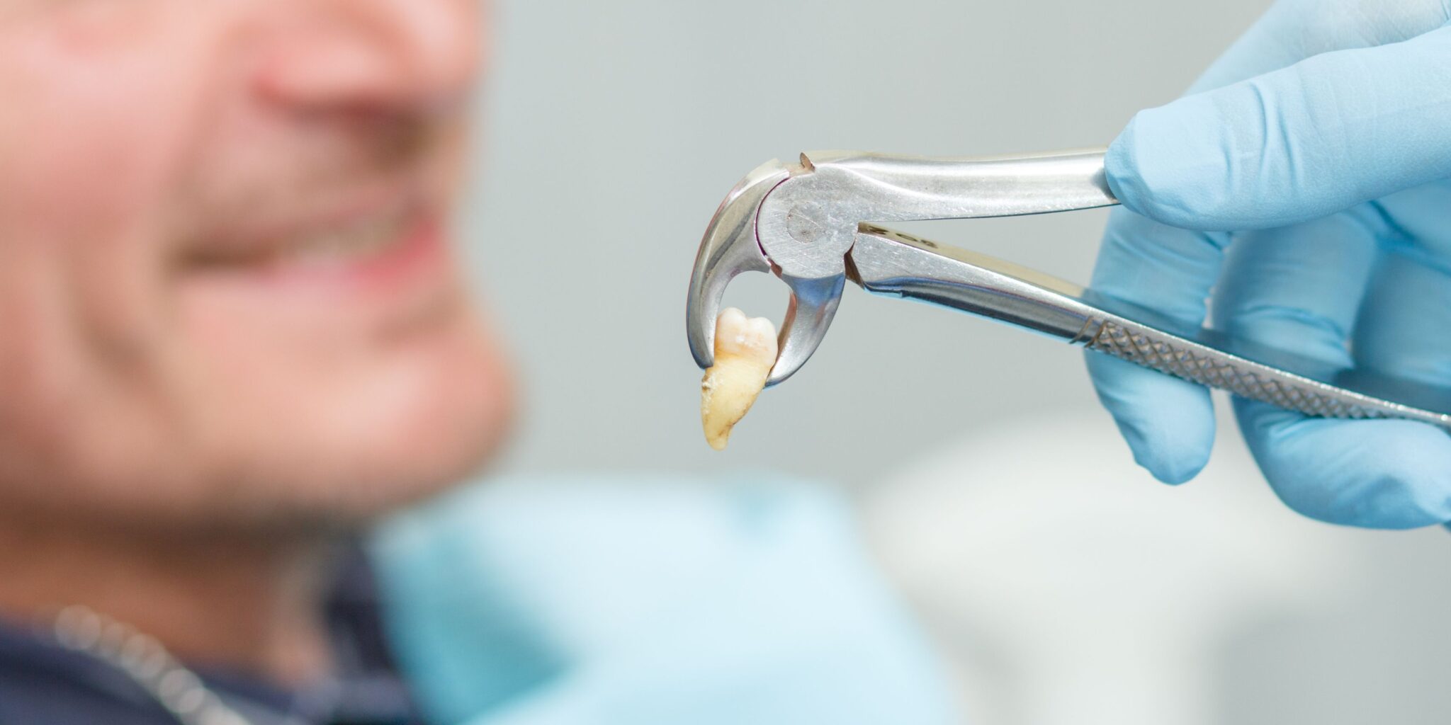 Dental Tooth Extraction Dallas