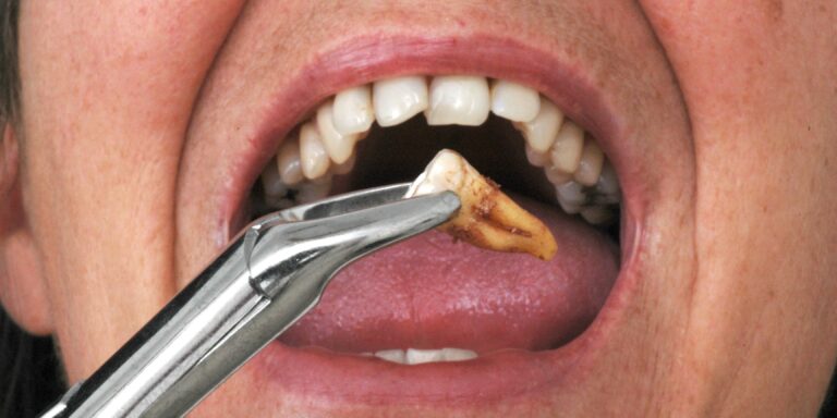 Tooth extraction dallas tx