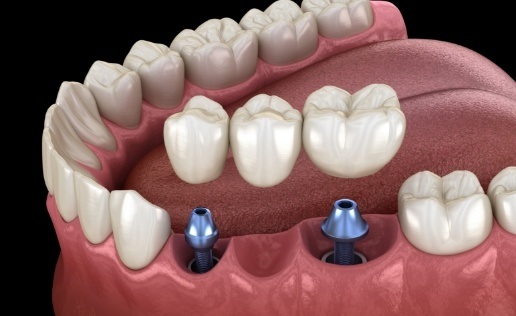 dental implants dallas, tx